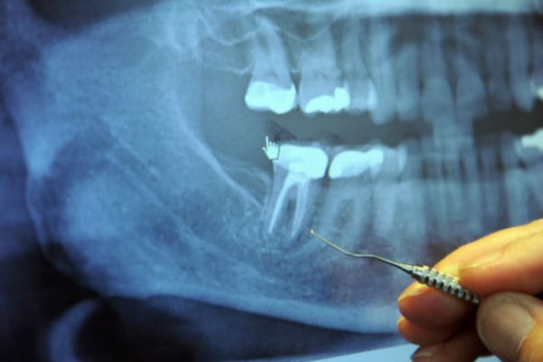 Rezultat slika za Nova šokantna saznanja: 97% oboljelih od raka i drugih teških bolesti, imali su ovaj zahvat na zubima