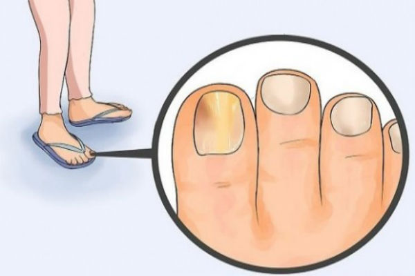 Slikovni rezultat za Mnogi ne znaju da je samo jedan sastojak dovoljan za potpuno uklanjanje gljivica!