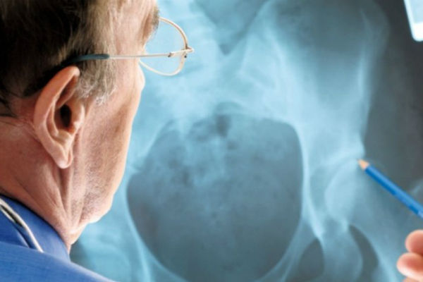 bol u kukovima pomaže artroza moderno liječenje